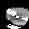 SPORK, NICO - 22.03.1976 - 02.08.2022 - CT obere Extremität - 17:51:17